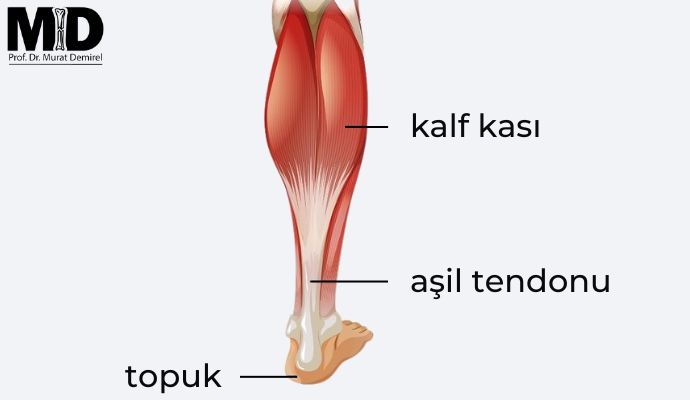 Aşil tendonu kopması (yırtılması) nedir? Ankara